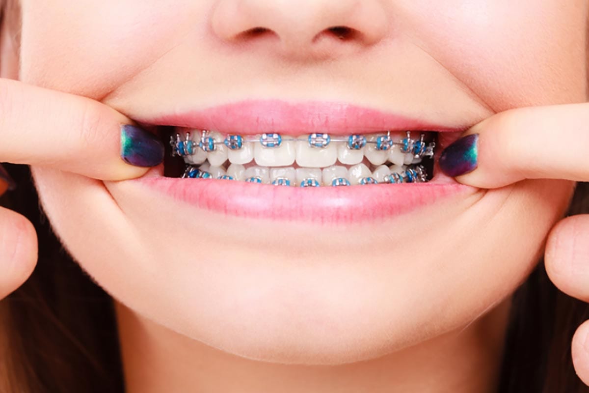 Loose, Broken, or Poking Orthodontic Appliance? Here’s How to Fix It
