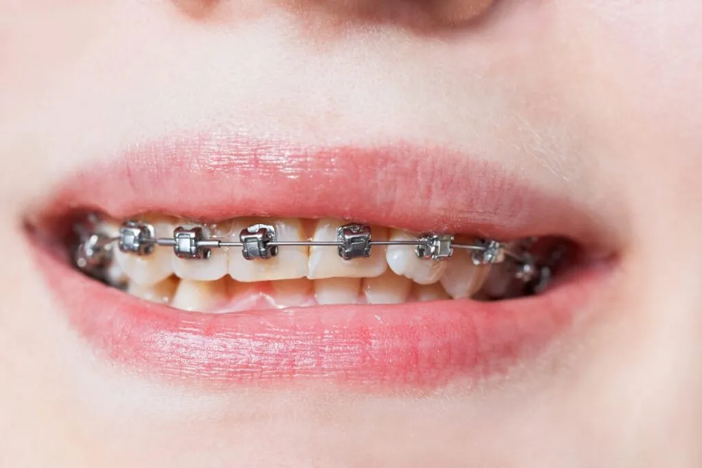 Damon Smile Self-ligating Braces