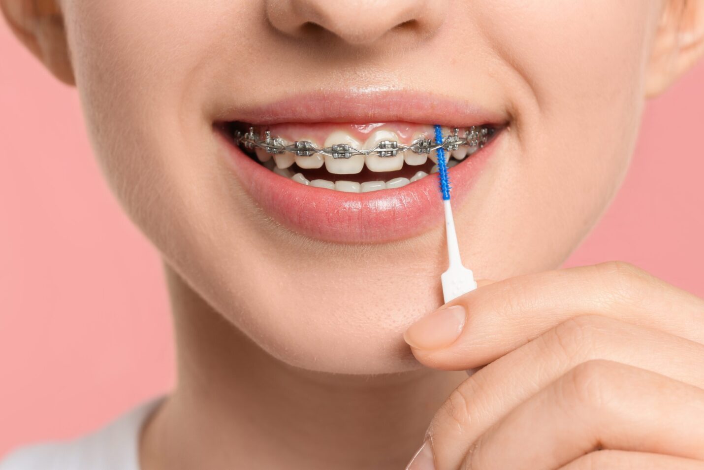 Oral hygiene with braces